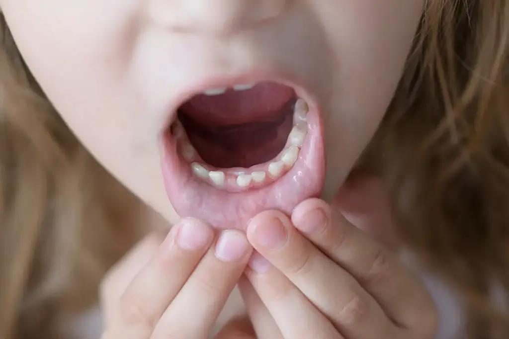 Caring for Children’s Teeth