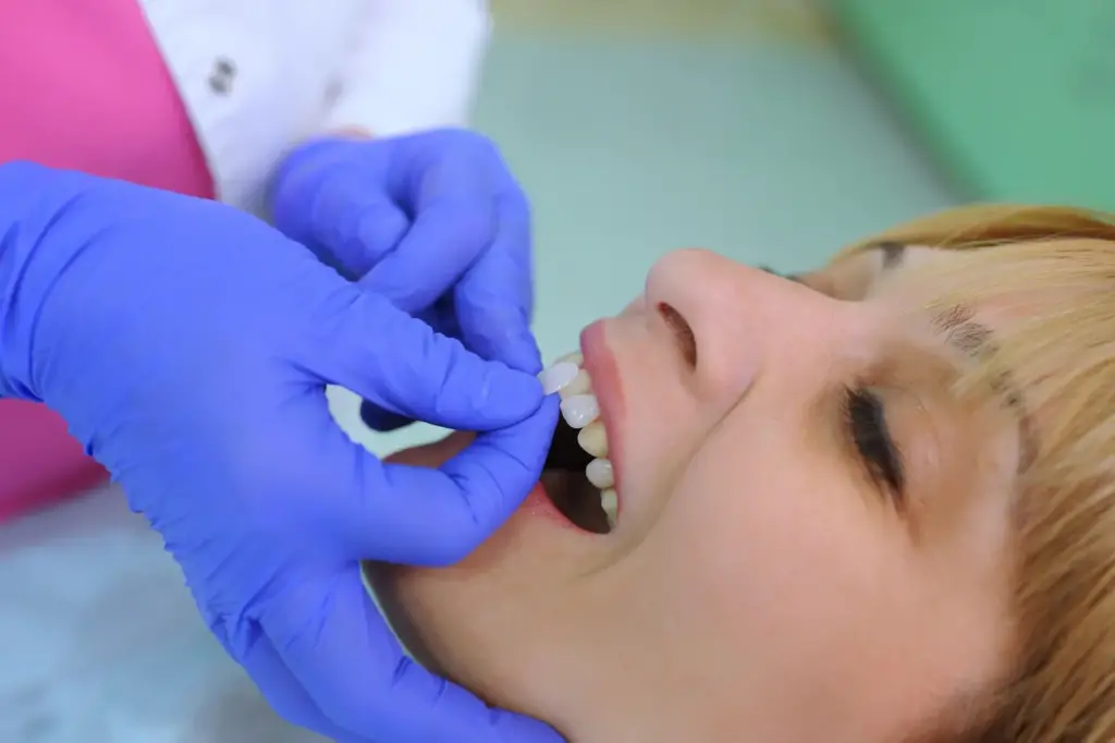 Invisalign vs. Veneers