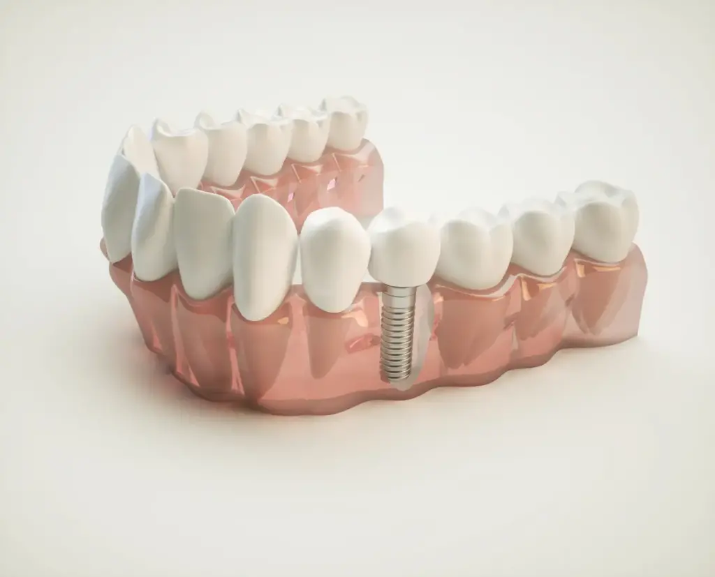 3D Dental Implant Tips for Dental Implant Recovery